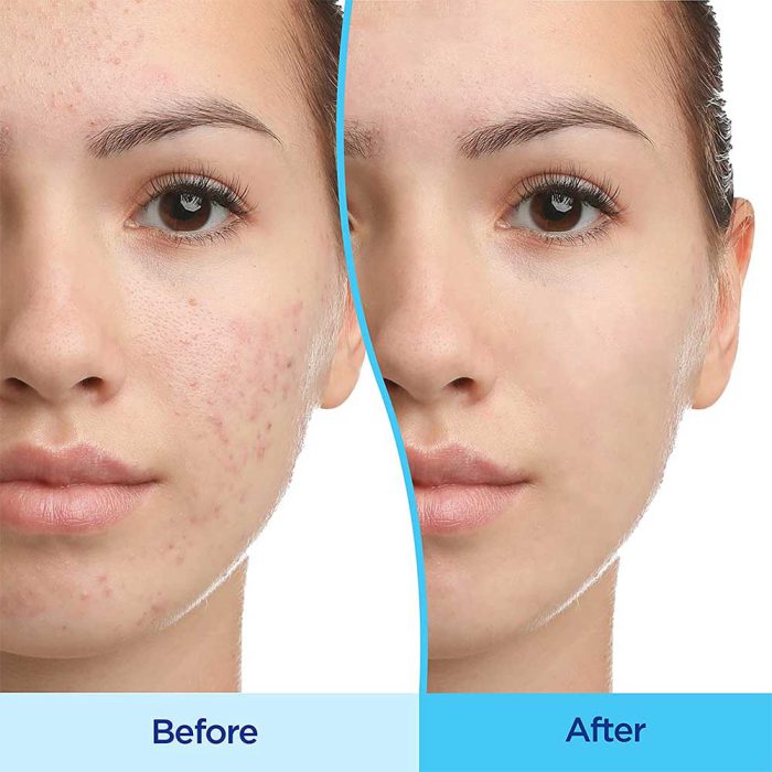 خرید و قیمت ژل ضد جوش ديفرين Differin gel 30g