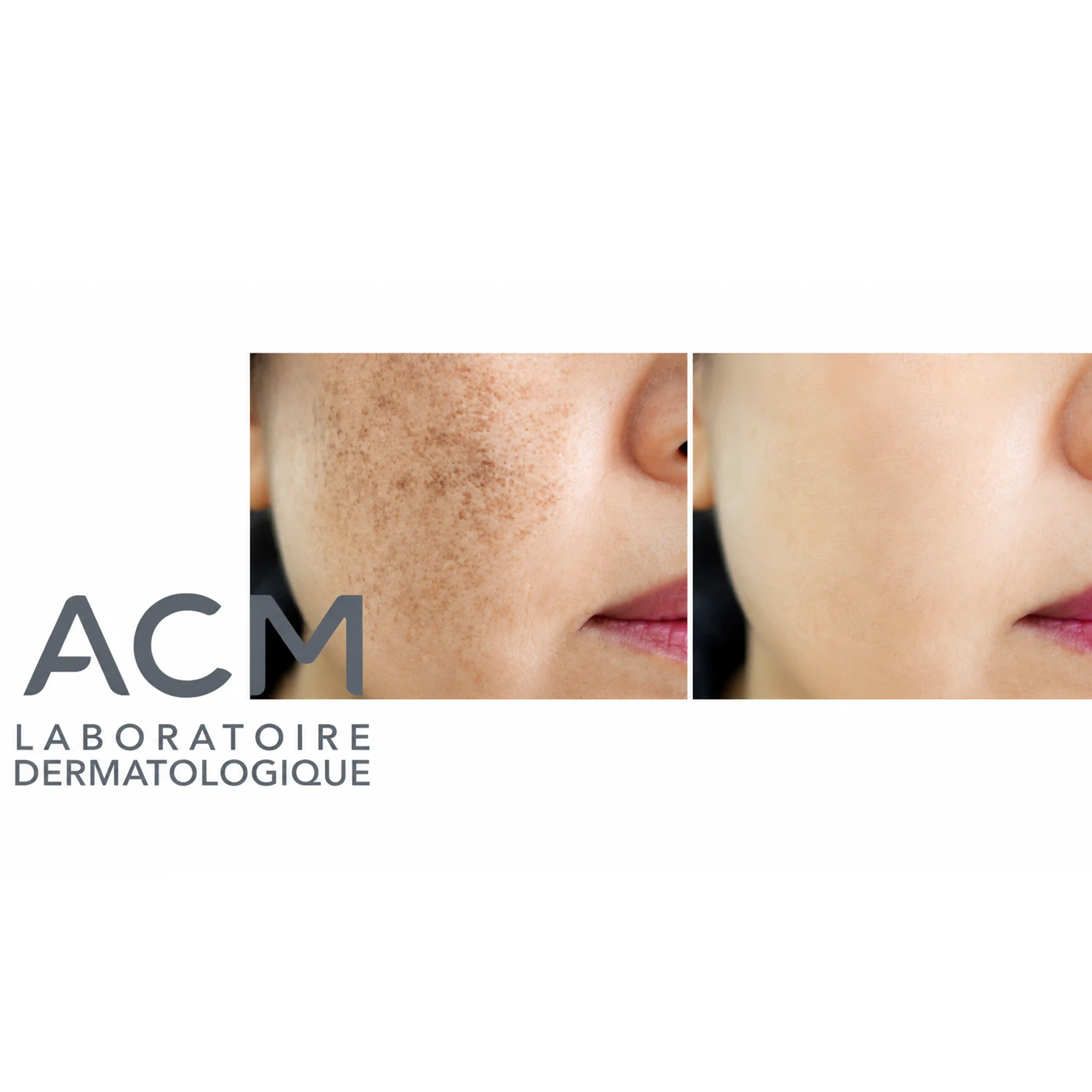 خرید و قیمت كرم ضد لک ACM DEPIWHITE 40ml